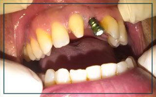 Clínica Dental Óscar Neme prótesis 
